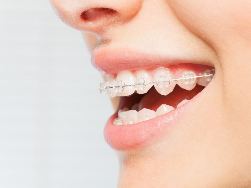 Cabinet dentaire république - Dentiste Belleville sur Meuse - Orthodontie
